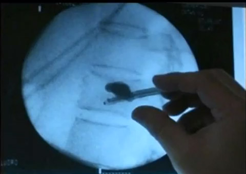 [Channel News Asia, Singapore] The Medical Touch (Bone Health) – Part 2